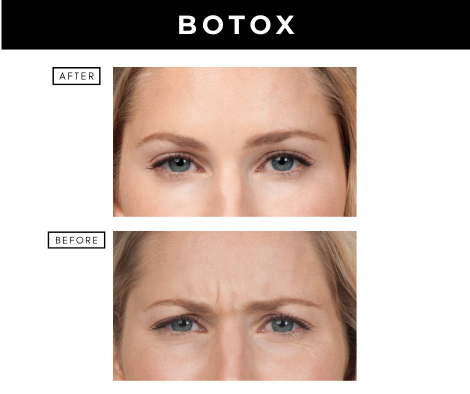 Botox cosmetic – patients of Dr. Nizar Merheb