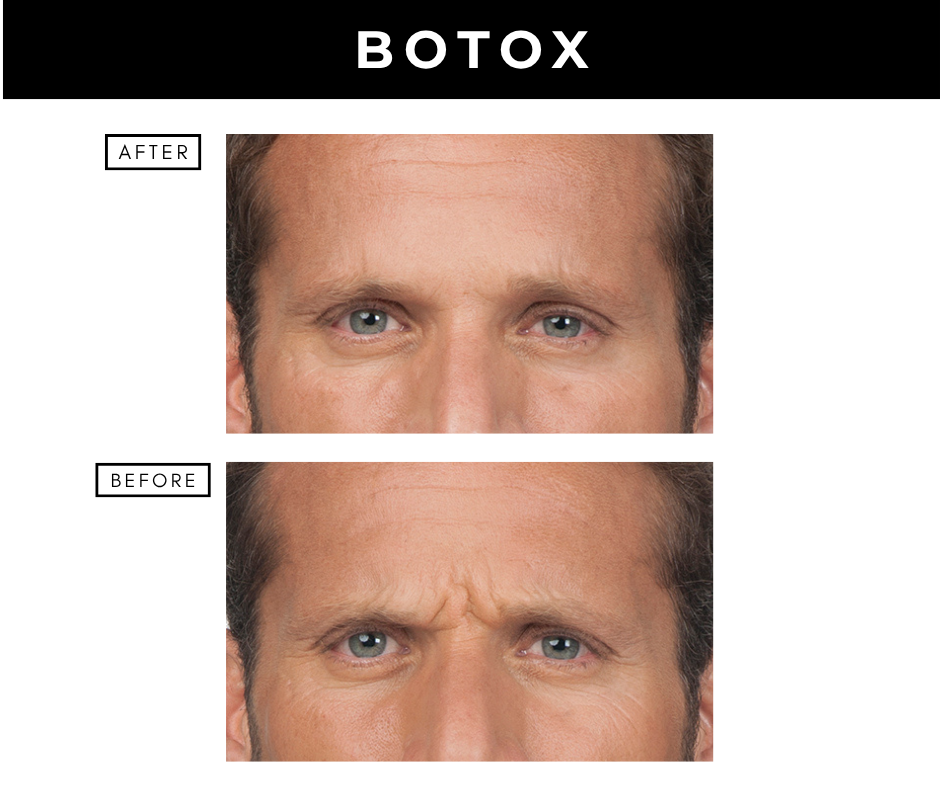 Botox cosmetic – patients of Dr. Nizar Merheb