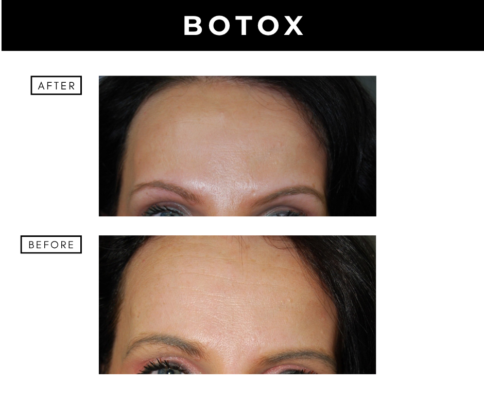 Botox cosmetic – patients of Dr. Nizar Merheb
