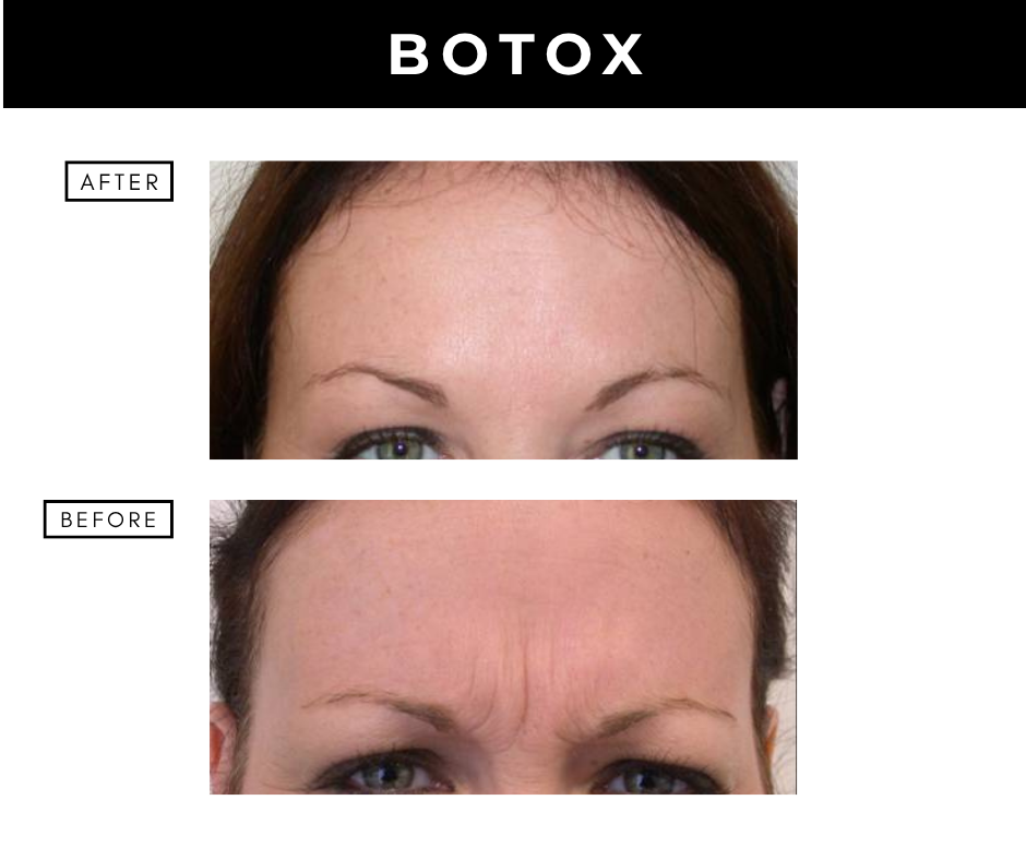 Botox cosmetic – patients of Dr. Nizar Merheb