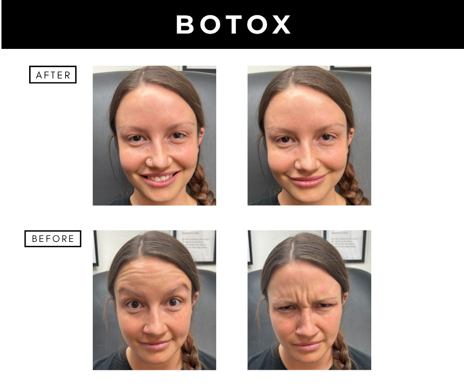 Botox cosmetic – patients of Dr. Nizar Merheb