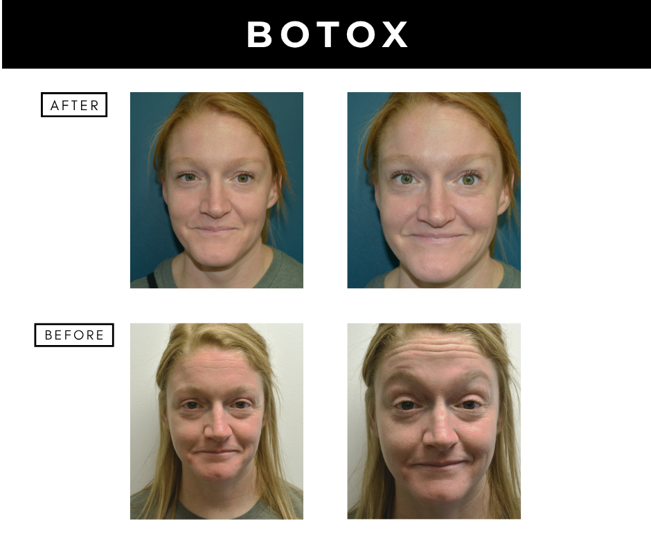Botox cosmetic – patients of Dr. Nizar Merheb