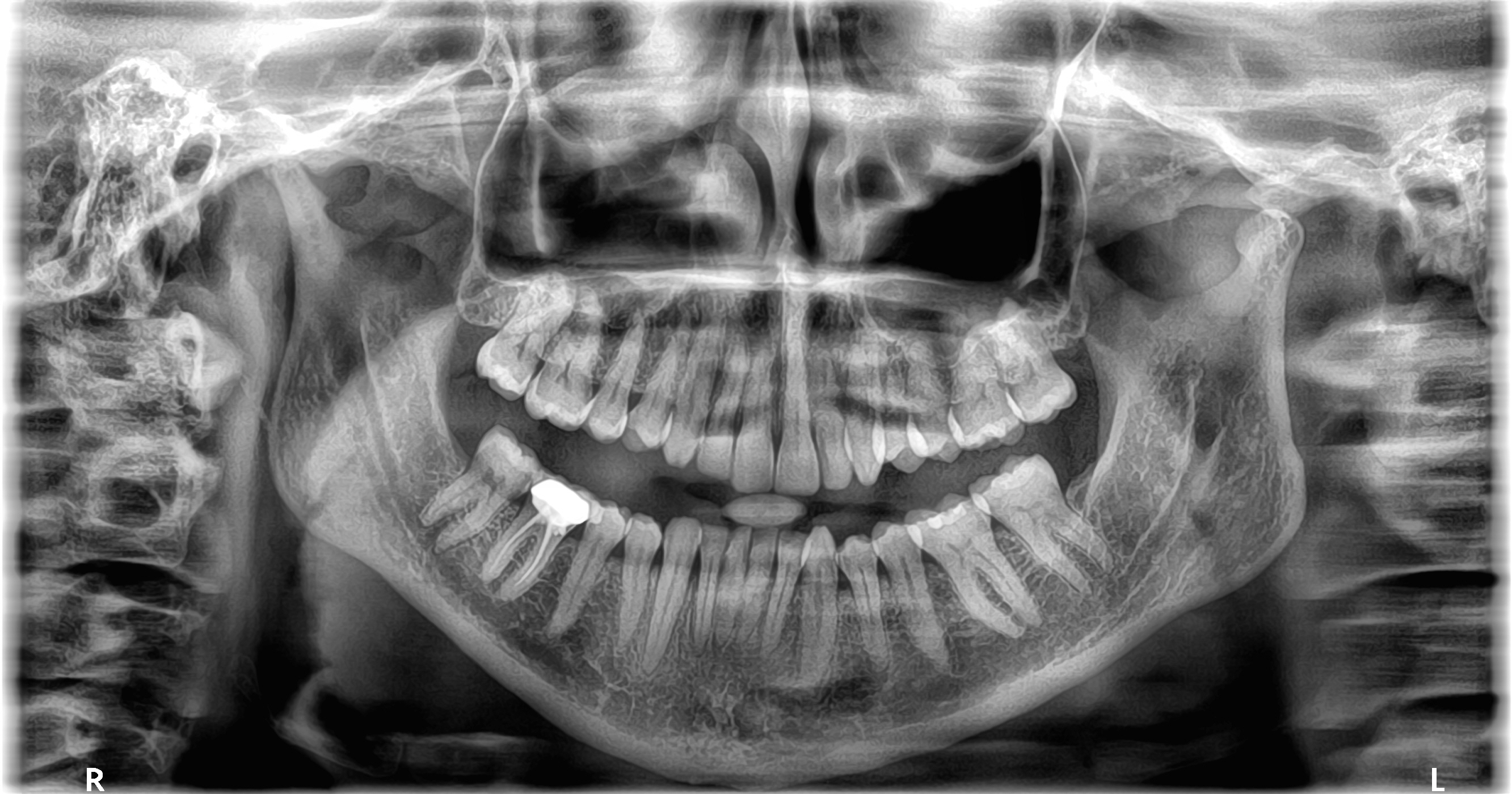 digital image of a dental implant