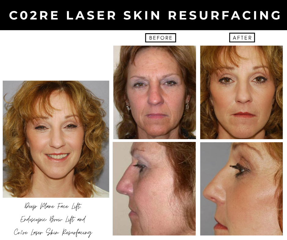 Laser Skin Resurfacing – patients of Dr. Nizar Merheb