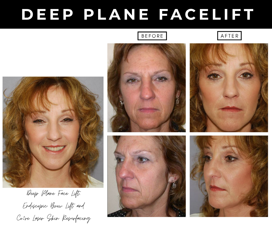 Deep plane facelift – patients of Dr. Nizar Merheb