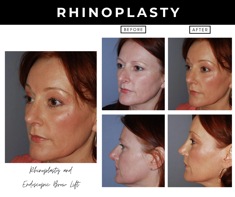 rhinoplasty – patients of Dr. Nizar Merheb