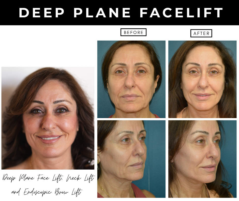 Deep plane facelift – patients of Dr. Nizar Merheb