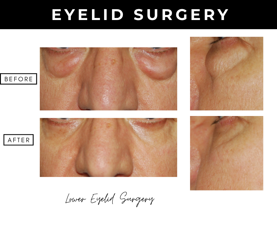 Eyelid surgery – patients of Dr. Nizar Merheb