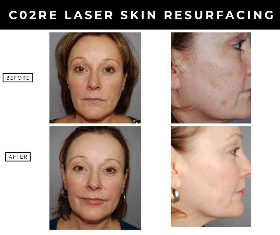 Laser Skin Resurfacing – patients of Dr. Nizar Merheb