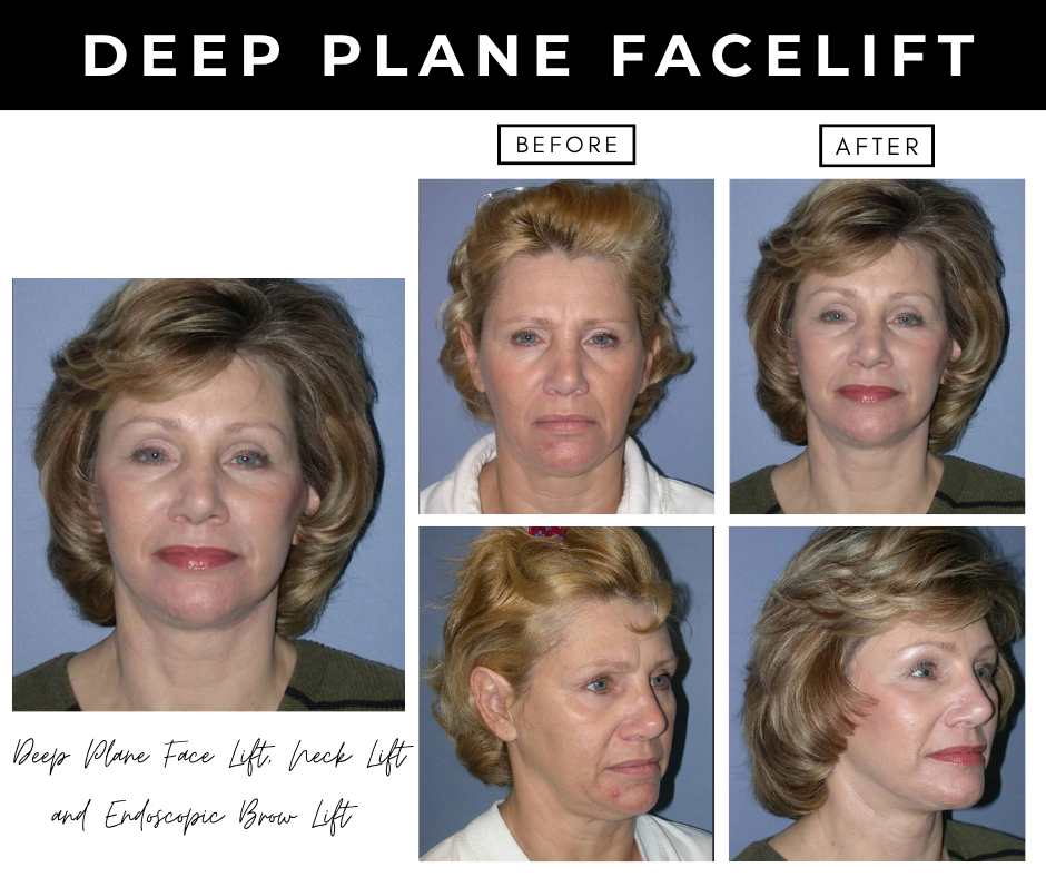 Deep plane facelift – patients of Dr. Nizar Merheb
