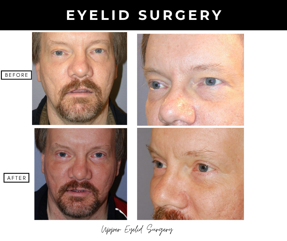 Eyelid surgery – patients of Dr. Nizar Merheb