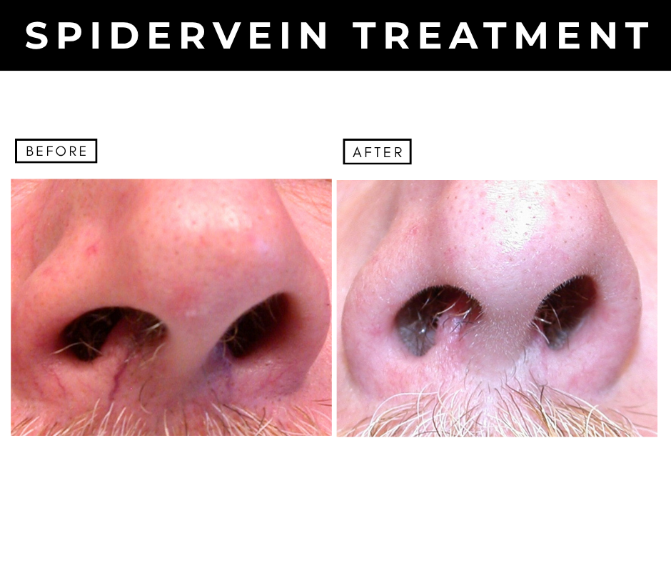 Scarless mole removal – patients of Dr. Nizar Merheb