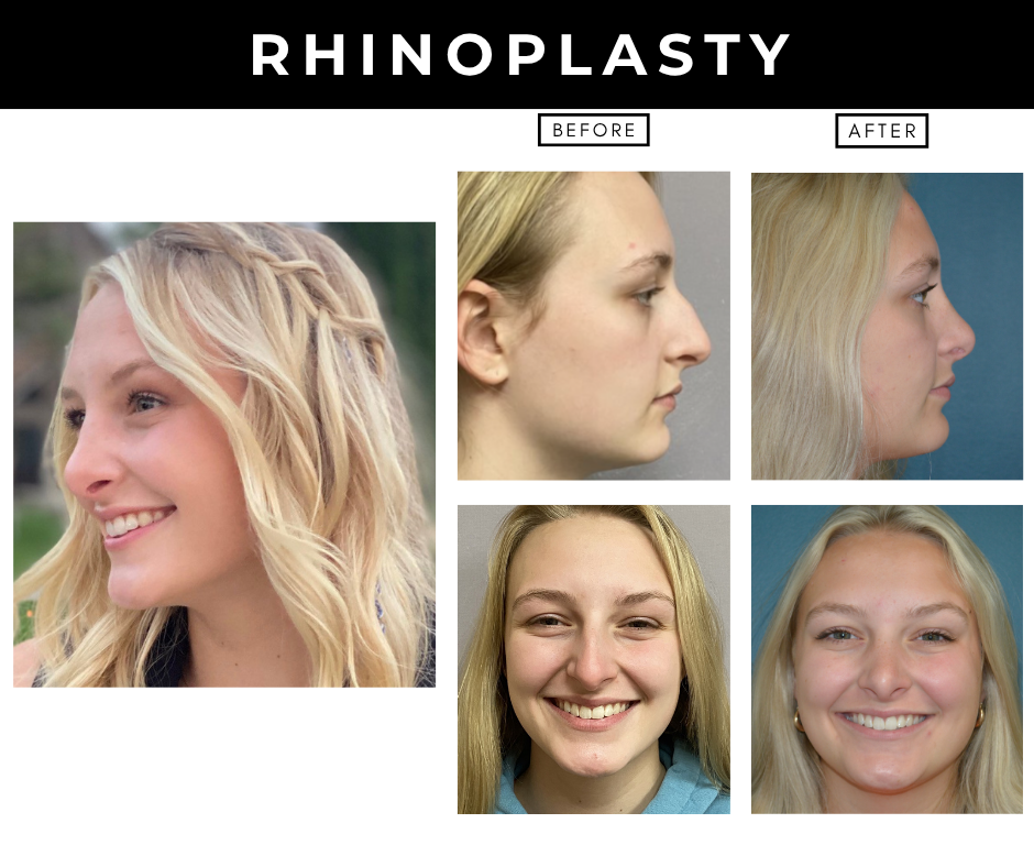 rhinoplasty – patients of Dr. Nizar Merheb