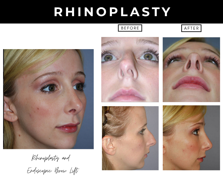 rhinoplasty – patients of Dr. Nizar Merheb