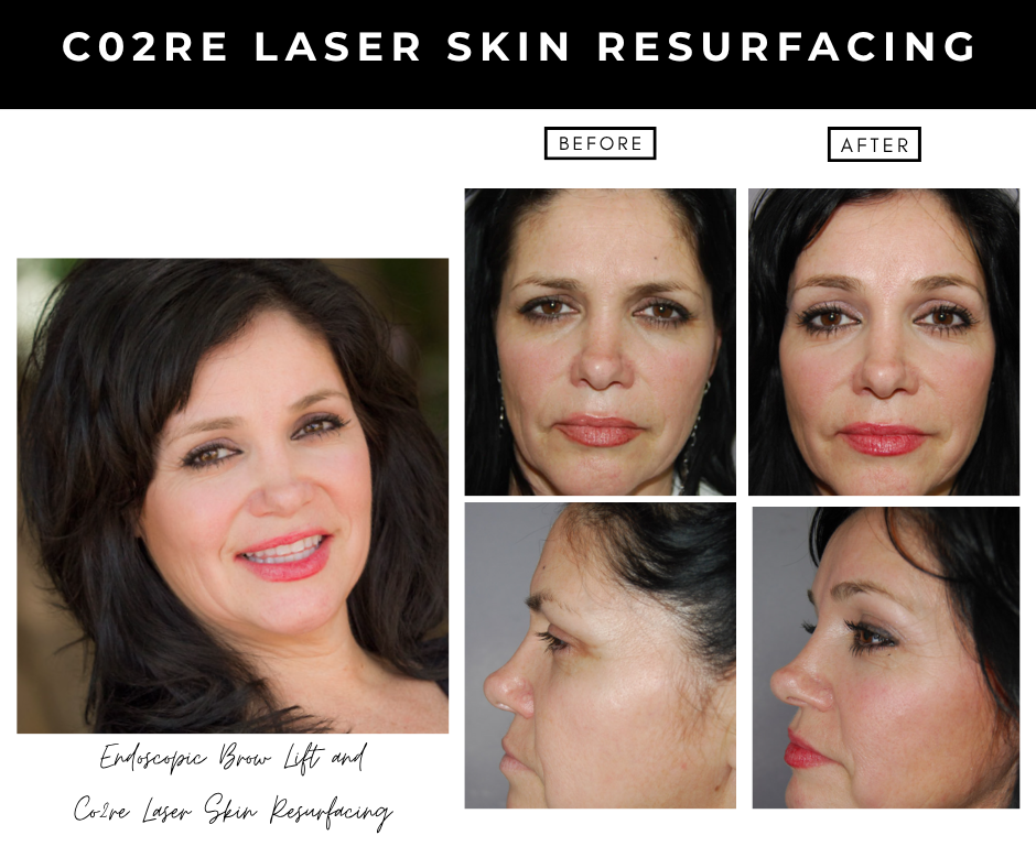 Laser Skin Resurfacing – patients of Dr. Nizar Merheb