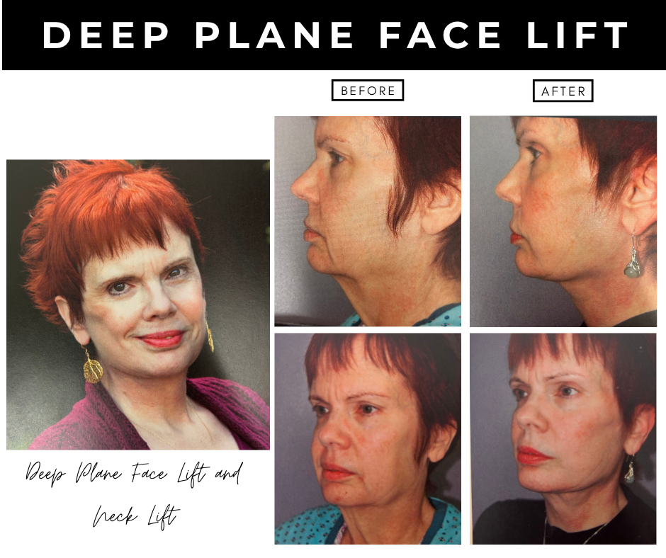 Deep plane facelift – patients of Dr. Nizar Merheb