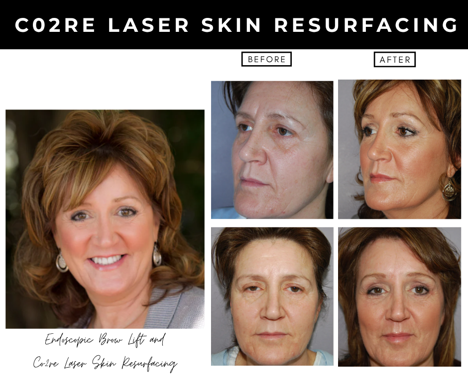 Laser Skin Resurfacing – patients of Dr. Nizar Merheb