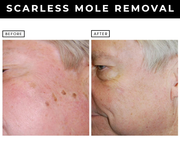 Scarless mole removal – patients of Dr. Nizar Merheb